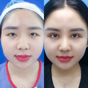 Mở rộng góc mắt là gì? Đối tượng phù hợp & những điều cần biết