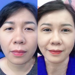 Trẻ hóa mắt là gì? Khi nào cần và các phương pháp thường áp dụng