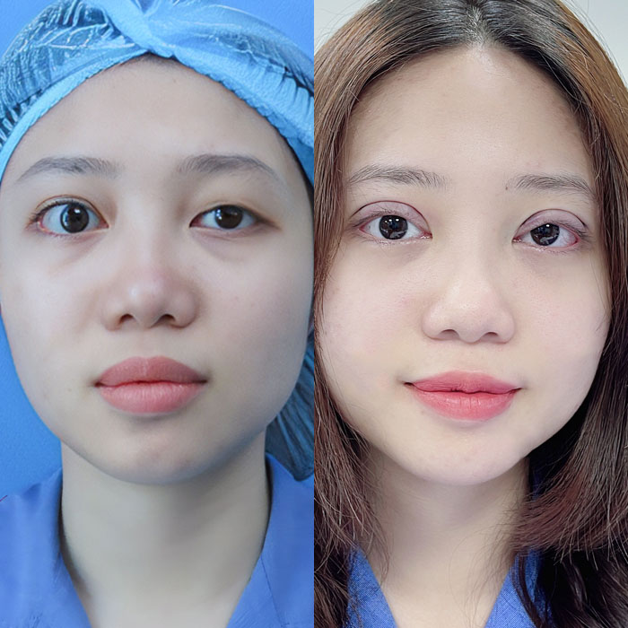 Sụp mí mắt là gì? Nguyên nhân, mức độ và hướng điều trị