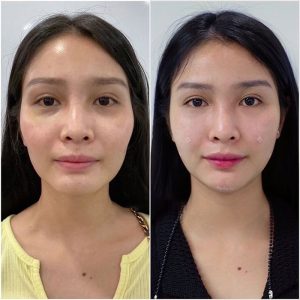 Cấy mỡ Bio Fat – Làm đầy gương mặt hốc hác