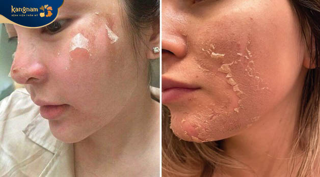 Da bong tróc, khô ráp sau khi peel