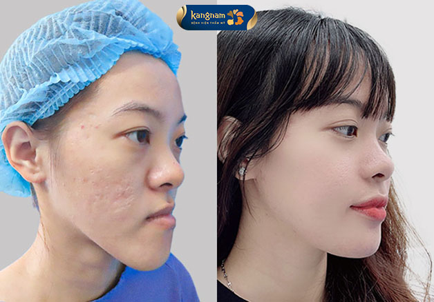 Chỉnh hàm móm là quá trình phẫu thuật nhằm cải thiện về mặt thẩm mỹ và chức năng của hàm mặt