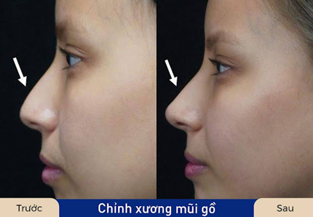 Chỉnh xương mũi gồ, tái tạo lại sống mũi thẳng, thanh tú