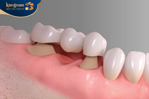 Chụp mão sứ vào cùi răng thật