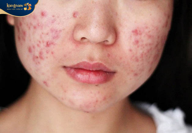 Da mặt xuất hiện nhiều mụn do dị ứng mỹ phẩm