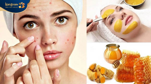 Đẩy lùi mụn an toàn bằng mật ong