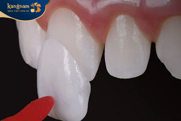 Dán răng sứ
