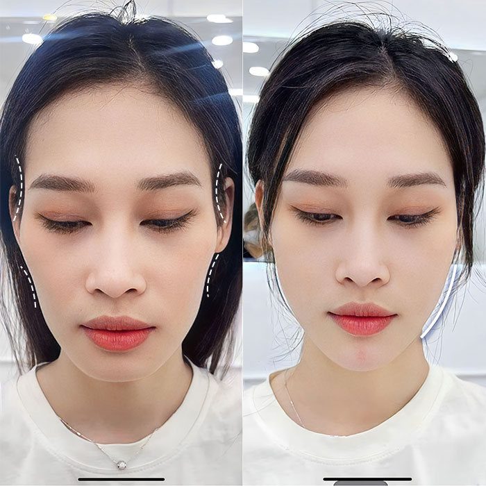 Tiêm filler là gì? Các loại filler phổ biến và một số lưu ý