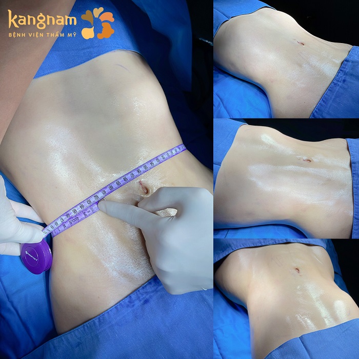 Kiến tạo vòng eo con kiến sau giảm mỡ