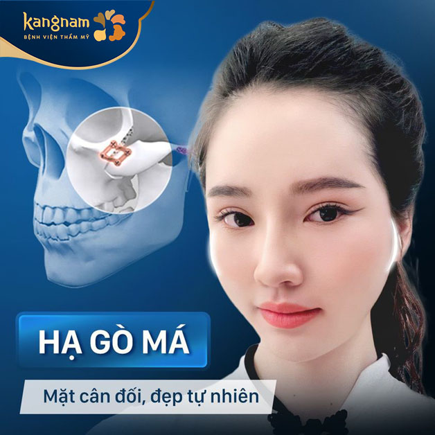 Kết quả hạ xương gò má giúp gương mặt cân đối, đẹp tự nhiên