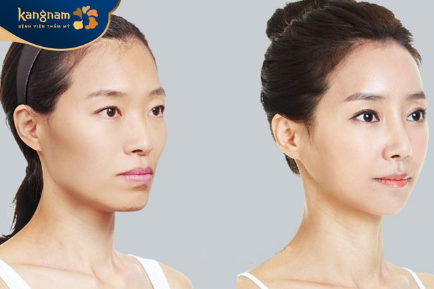 Phẫu thuật hạ xương gò má phù hợp với những người có xương gò má cao