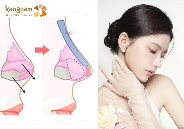 Nâng mũi cấu trúc sụn sườn Surgiform là kỹ thuật nâng mũi kết hợp giữa sụn sườn và sụn Surgiform