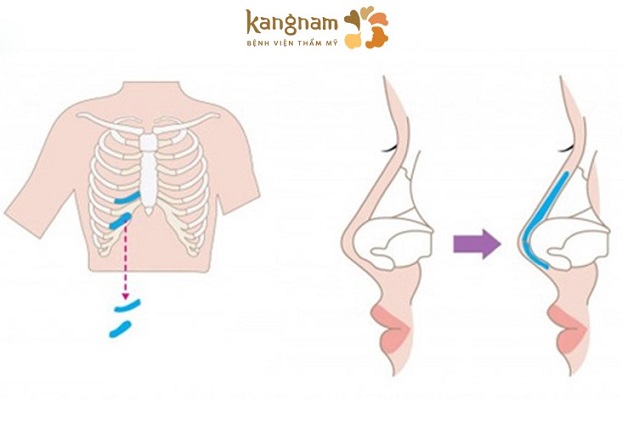 Công nghệ nâng mũi sụn sườn 100% sử dụng kỹ thuật nâng mũi đặc biệt cùng chất liệu 100% sụn sườn tự thân