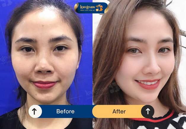 Khách hàng tự tin với dáng mũi mới khi khuyết điểm trên mũi đã được loại bỏ