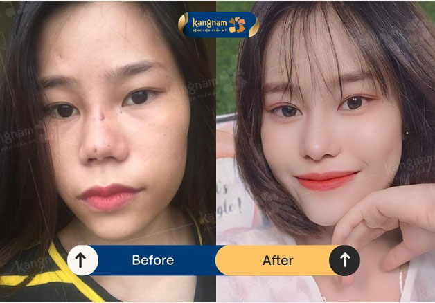 Mũi hỏng bẩm sinh được khắc phục, khách hàng tự tin hơn trong diện mạo mới