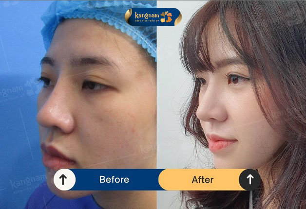 Lột xác với dáng mũi mới cao thẳng, đẹp tự nhiên