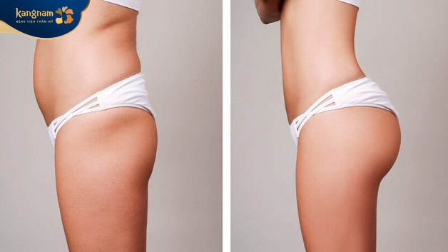 Cấy mỡ tự thân vào mông