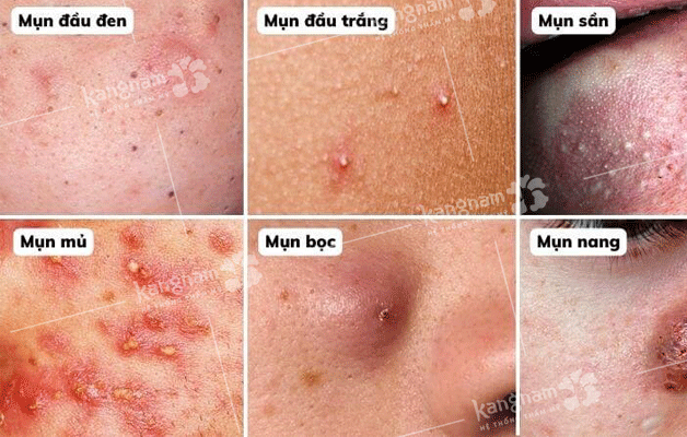 Các loại mụn phổ biến, thường gặp