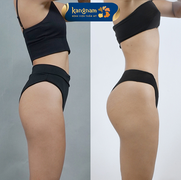 Có ngay vòng 3 căng tròn, quyến rũ sau khi độn mông tại Kangnam