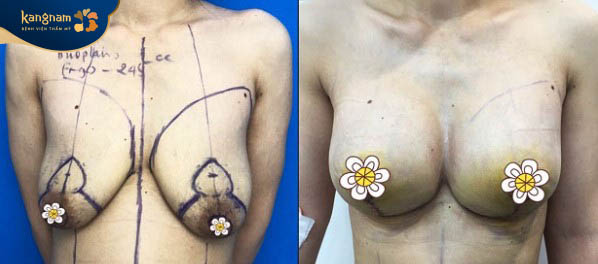 Sau treo sa trễ không để lại sẹo