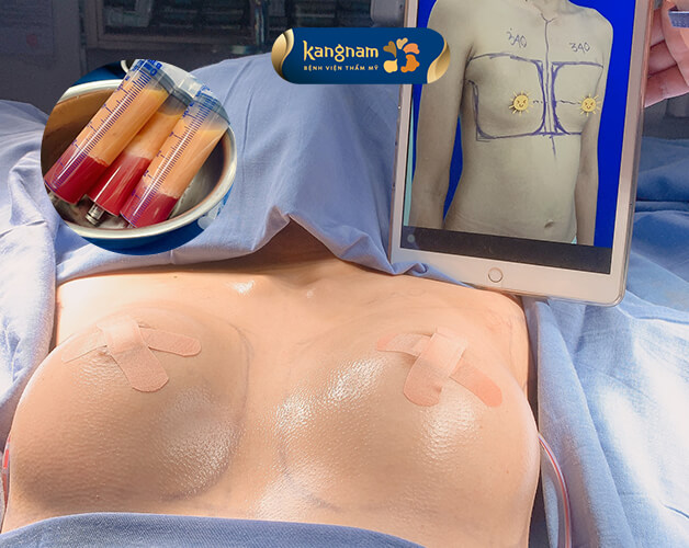 Nâng ngực bằng cấy mỡ tự thân