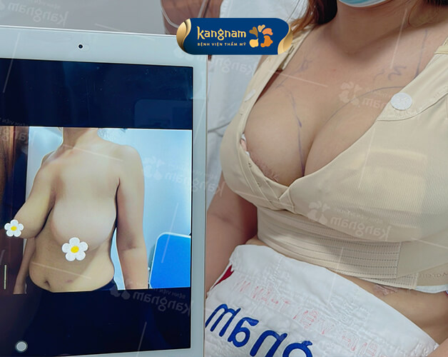 Treo ngực sa trễ tại Kangnam