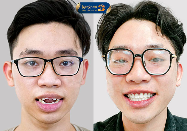 Răng khấp khểnh, không đều, niềng răng giúp dàn đều các răng, cải thiện chức năng ăn nhai