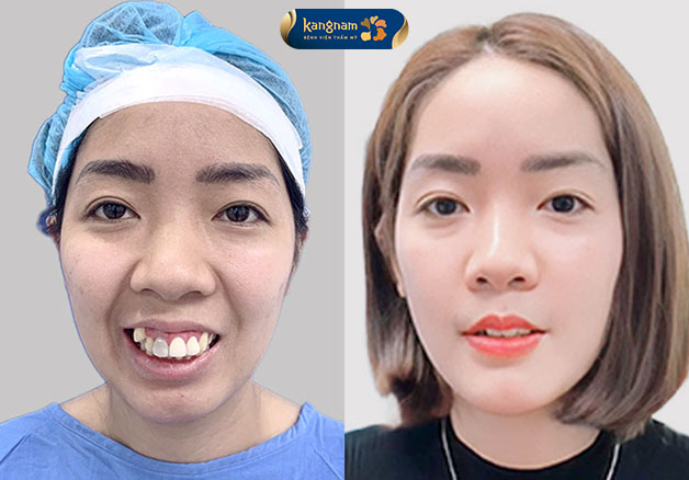 Niềng chỉnh nha tăng thêm tính thẩm mỹ cho toàn gương mặt