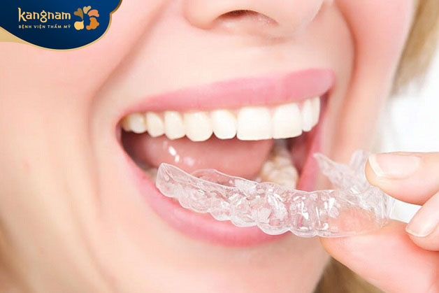 Niềng bằng khay tháo lắp