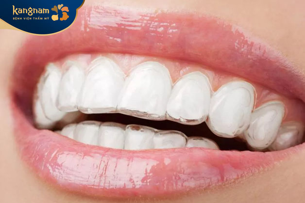 Niềng bằng khay trong suốt