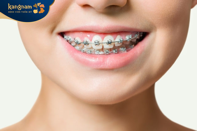 chỉnh nha có thể cải thiện vị trí của răng và xương hàm