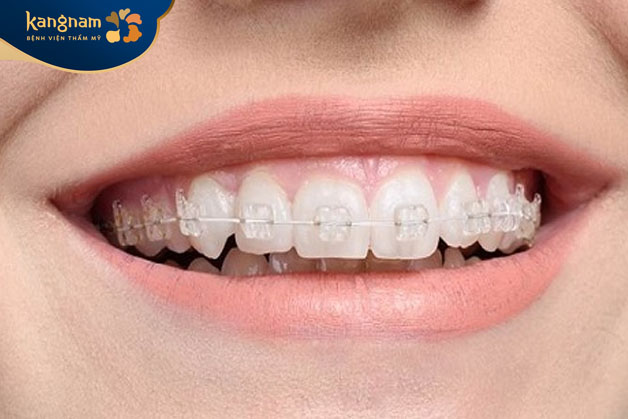 Niềng chỉnh nha mắc cài pha lê