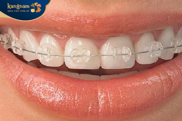 Niềng chỉnh nha mắc cài sứ