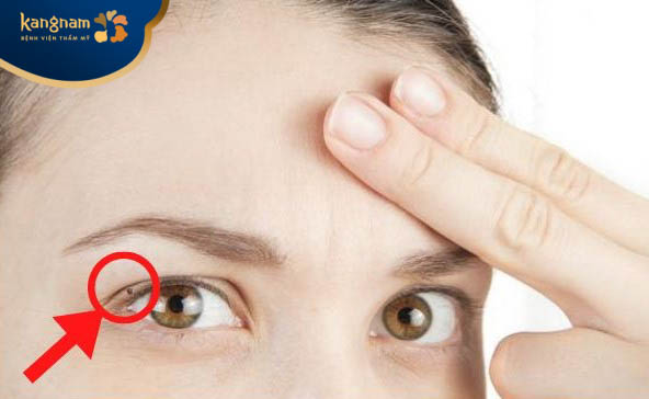 Người có nốt ruồi mọc ở mí mắt trên thường thiếu kiên nhẫn