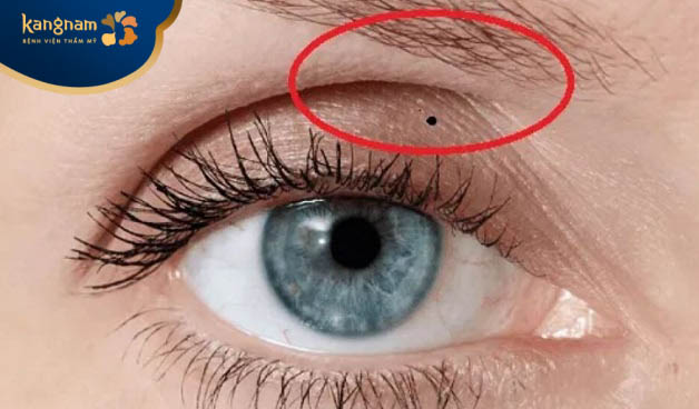Nốt ruồi mọc ở trên mí mắt thường xuất hiện ở bờ mi, kết mạc