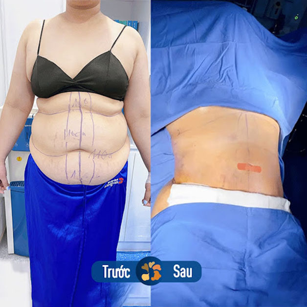 Giảm mỡ, loại bỏ da thừa, da chùng, giúp vòng 2 thon gọn