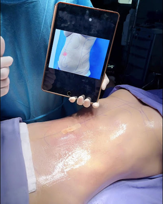 Khách hàng vừa thực hiện xong combo hút mỡ và tạo hình thành bụng