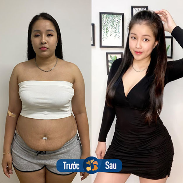 Lấy lại vóc dáng thon gọn chuẩn chữ S sau khi giảm mỡ, tạo hình bụng săn chắc