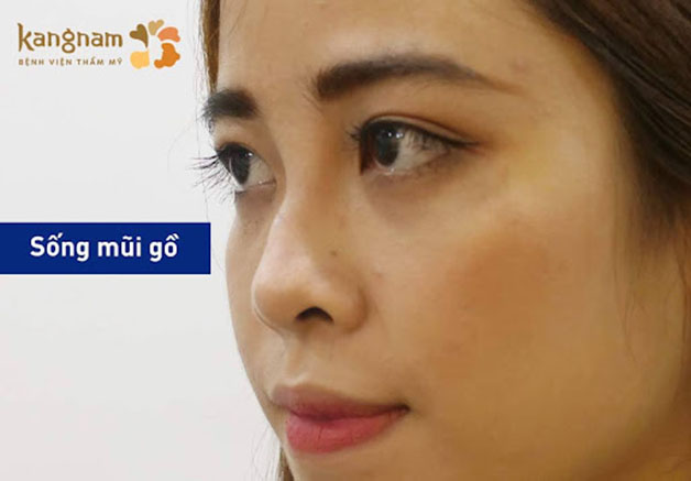 Mũi gồ là đặc điểm xương sống mũi nhô lên một phần, tạo ra đường gồ ghề trên sống mũi