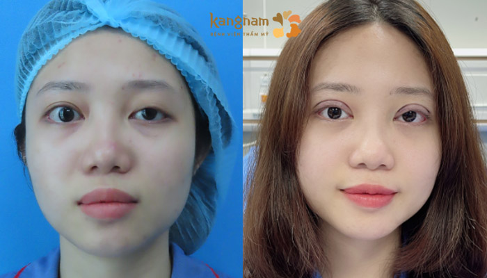 Treo cơ nâng mi chỉnh hình sụp mí phù hợp với trường hợp cơ nâng mi yếu