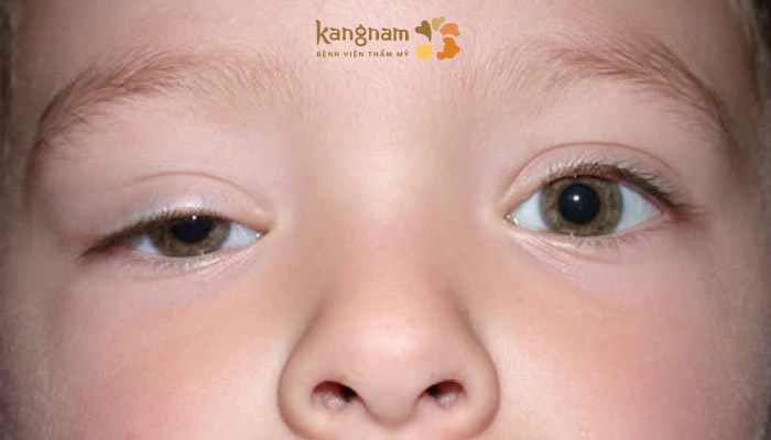 Tình trạng sụp mí bẩm sinh