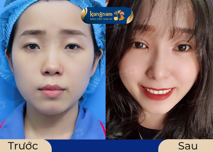 Sau mở khóe mắt đôi mắt của khách hàng to tròn và long lanh hơn