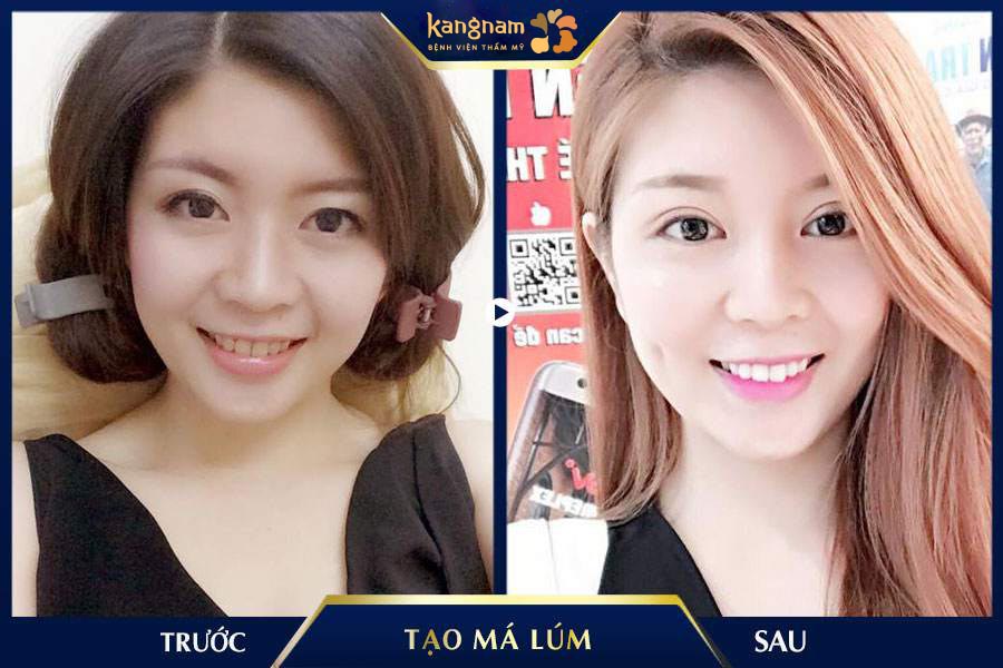 Má lúm đẹp tự nhiên như chưa từng can thiệp thẩm mỹ