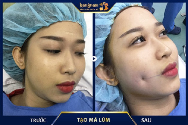 Dáng má lúm sau khi mới tạo hình