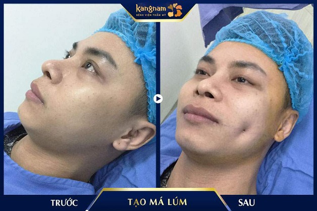 Khách hàng sau khi mới tạo hình má lúm xong