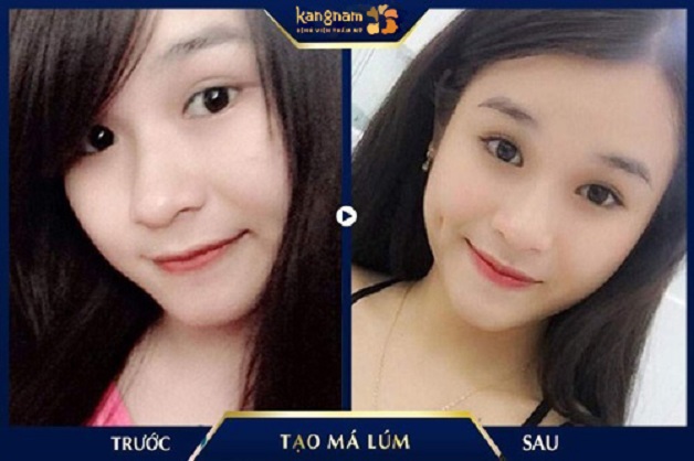 Khách hàng hài lòng với dáng má lúm mới được tạo hình