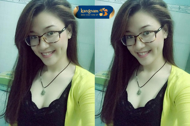 Gương mặt tươi tắn, rạng rỡ sau tạo hình má lúm