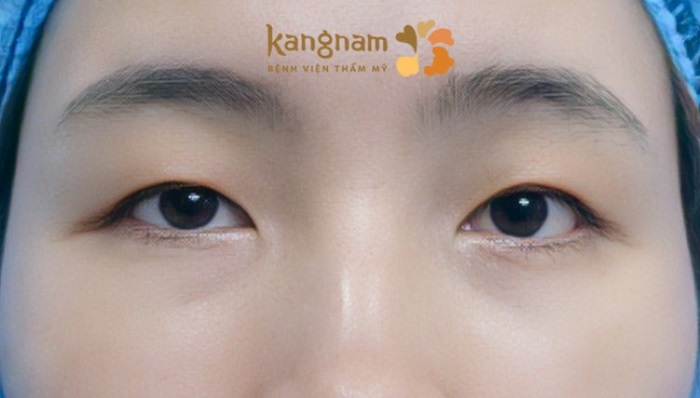 Mắt 1 mí là dáng mắt có mí nhỏ, không lộ rõ hoặc không có mí mắt