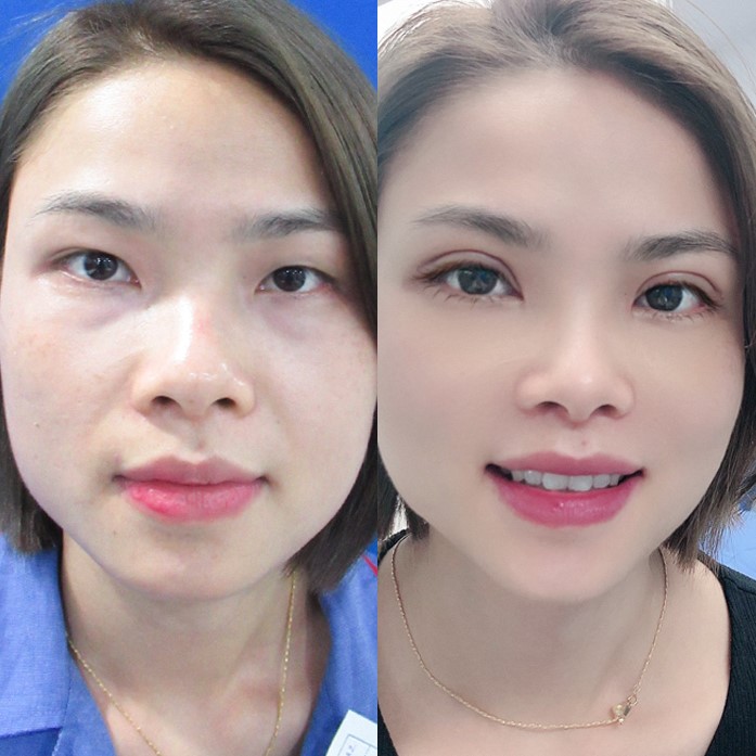 Tạo mắt 2 mí là gì? Các phương pháp phổ biến & đối tượng phù hợp