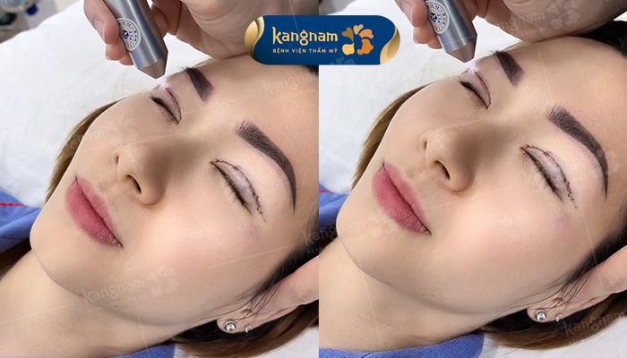 Chiếu tia plasma, hồi phục lành thương nhanh x2 lần